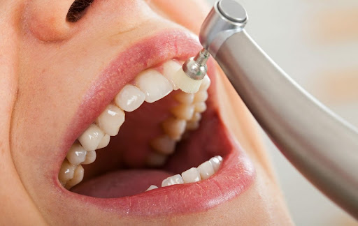 dental-implants - Newark Family Dental