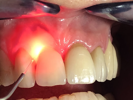 laser-gum-therapy - Newark Family Dental