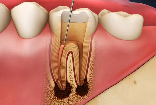 dental-implants - Newark Family Dental